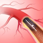 Angioplasty & Stenting